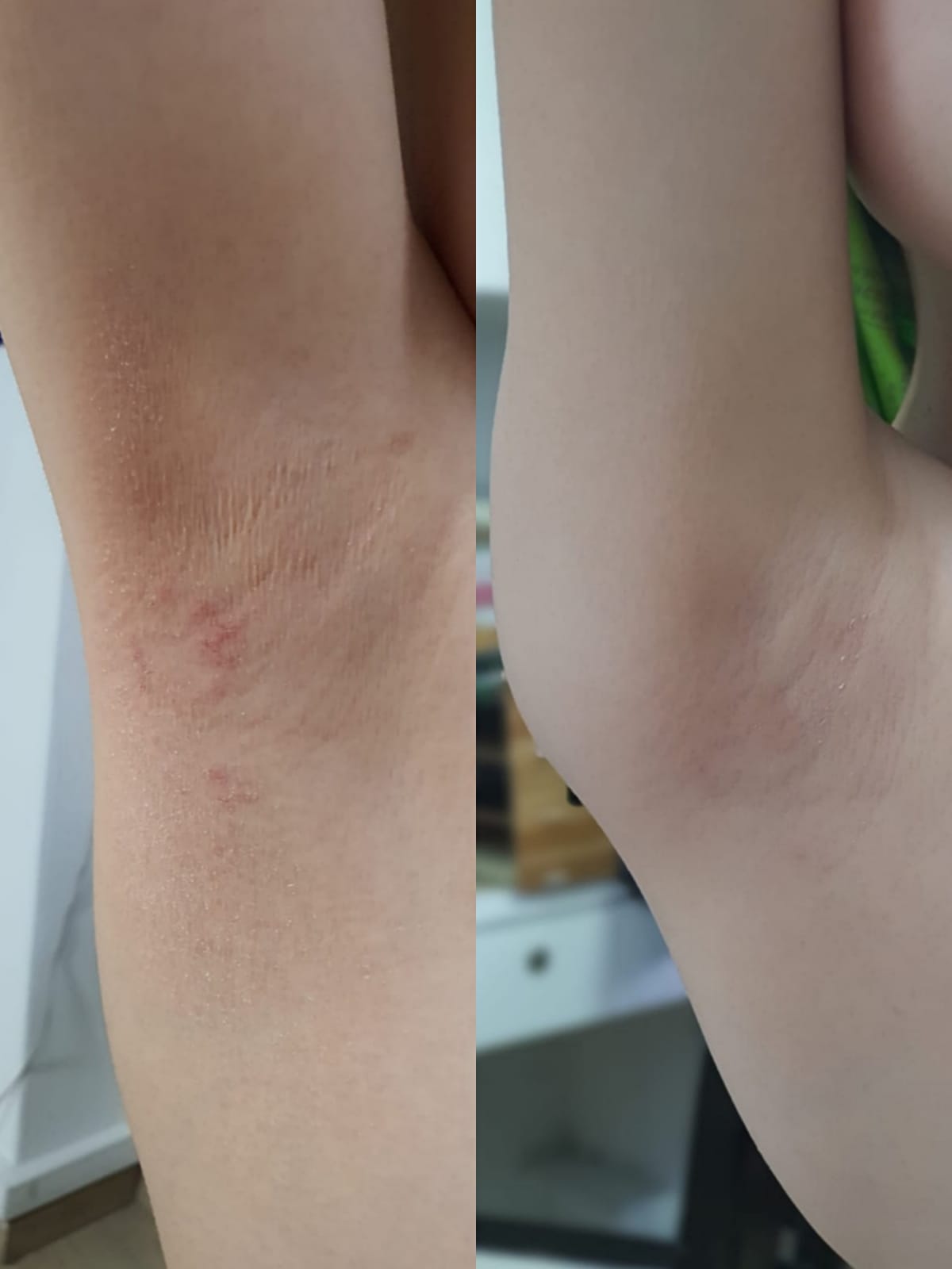 WhatsApp Image 2020-10-26 at 5.00.11 PM Pic of before and after eczema cured with 4 days